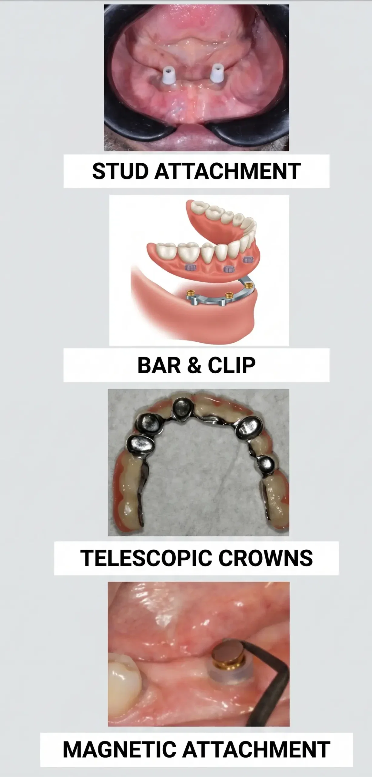 Overdenture Attachment Types