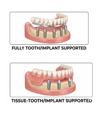Overdenture Support Systems