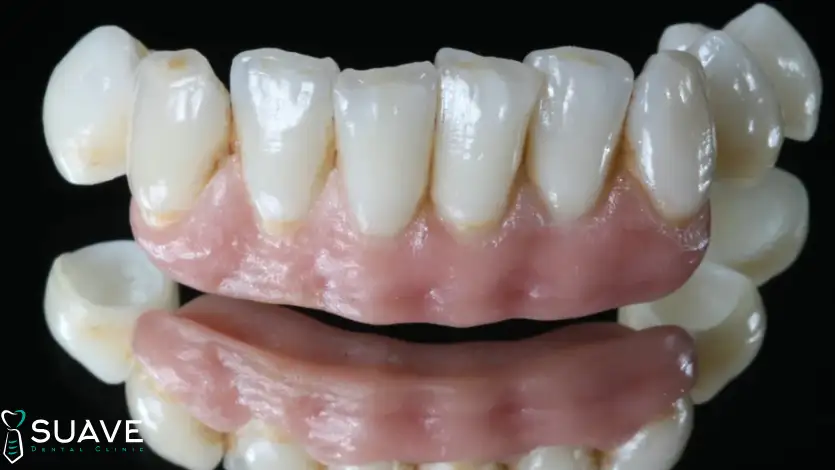 Gum Veneers 6 gingival pink porcelain as a permanent solution for localized receding gums