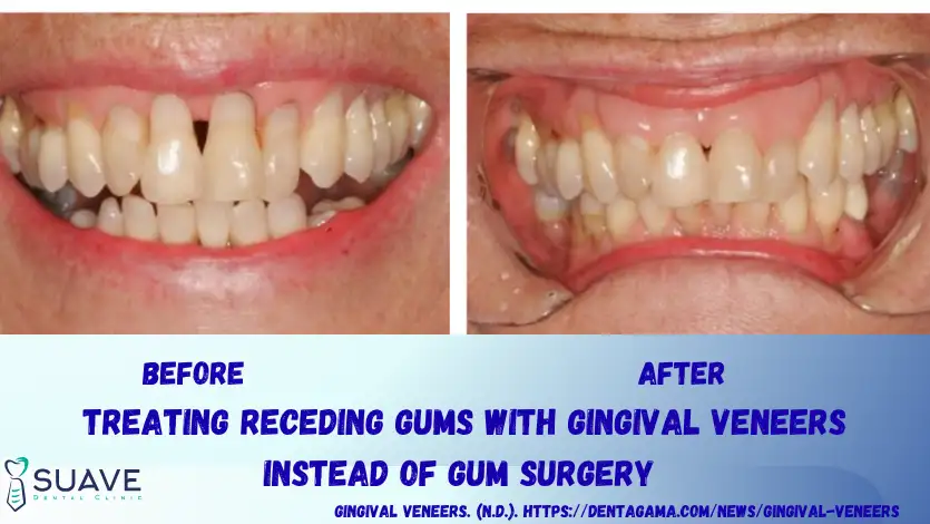 Gum Veneers 8 gingival veneers before and after - Suave Clinic