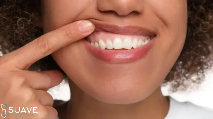 gum veneers as esthetic non-surgical solution for gum recession