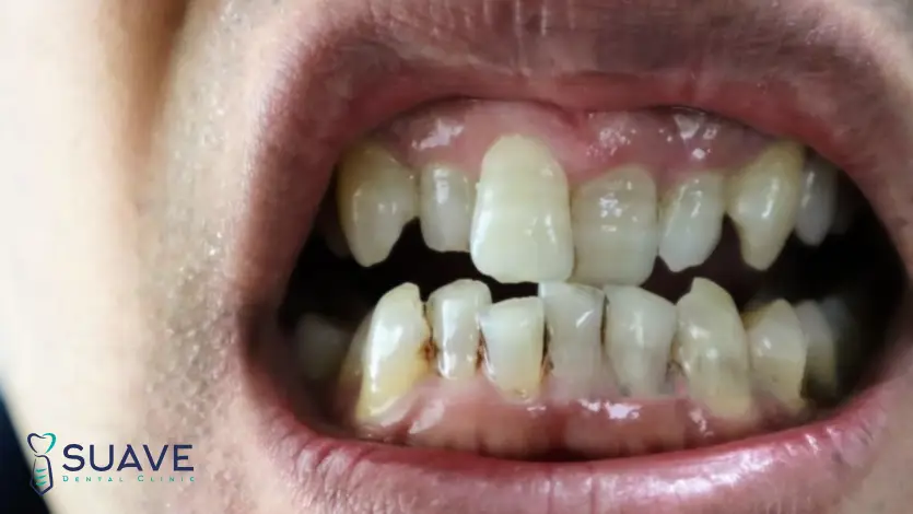 how to fix crowded teeth with Suave Clinic