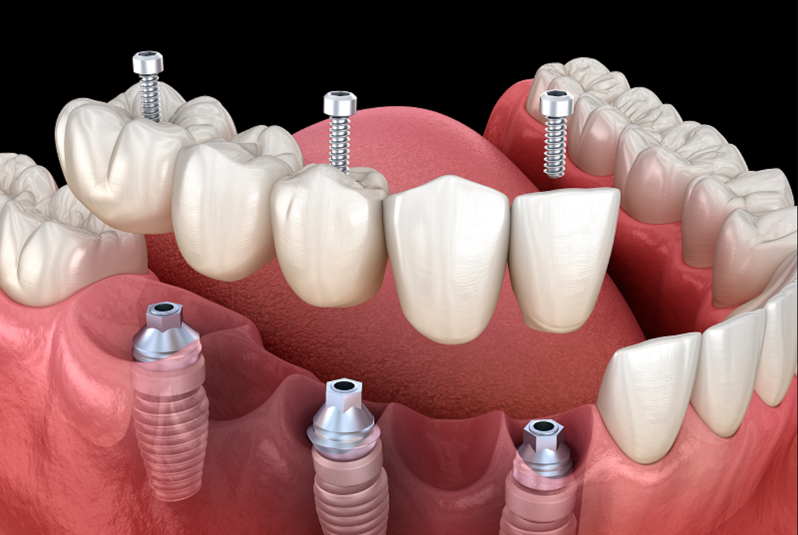 implant-supported bridge for multiple missing teeth 