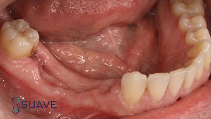 jawbone resorption treatment options at Suave Clinic