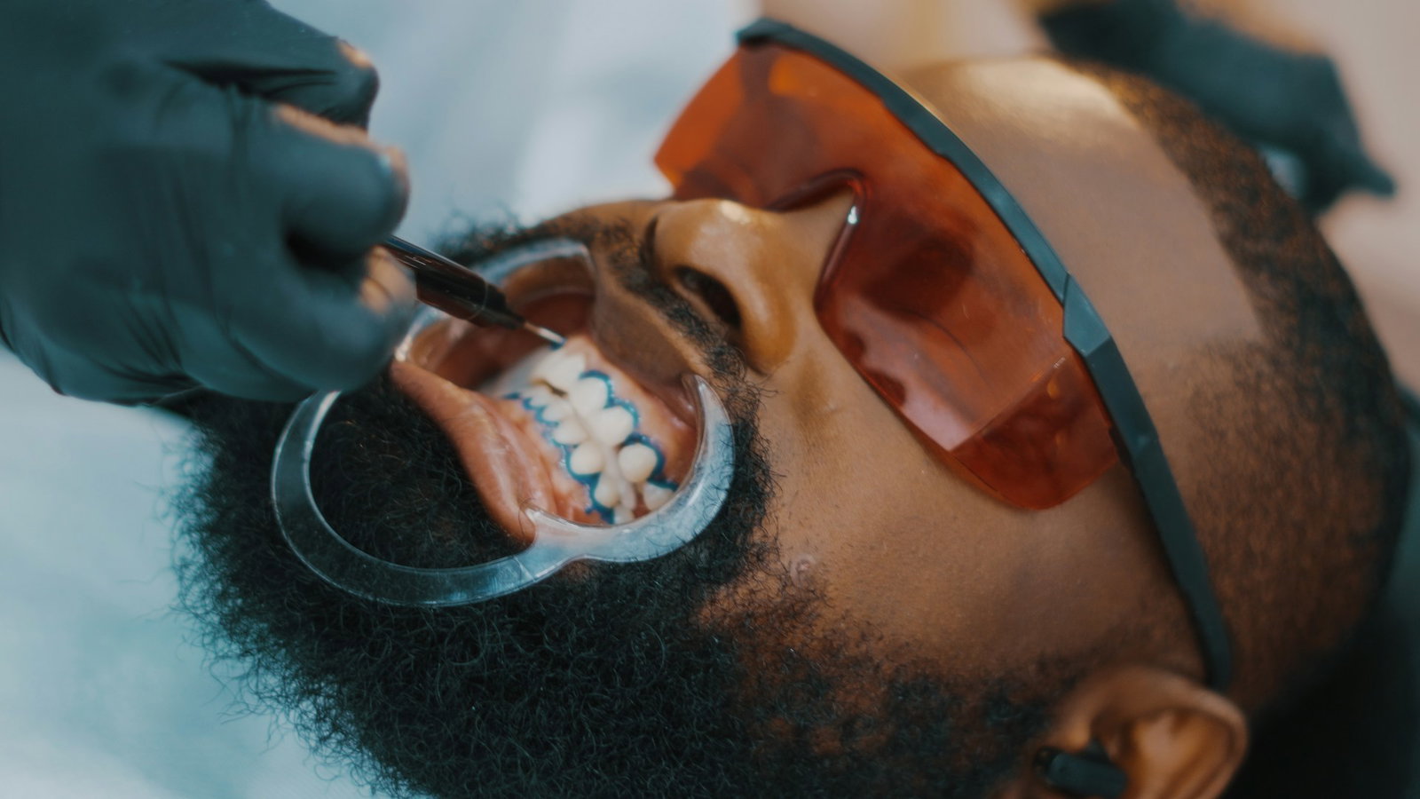 Teeth Whitening Service 6 laser teeth whitening in Suave Clinic Turkey