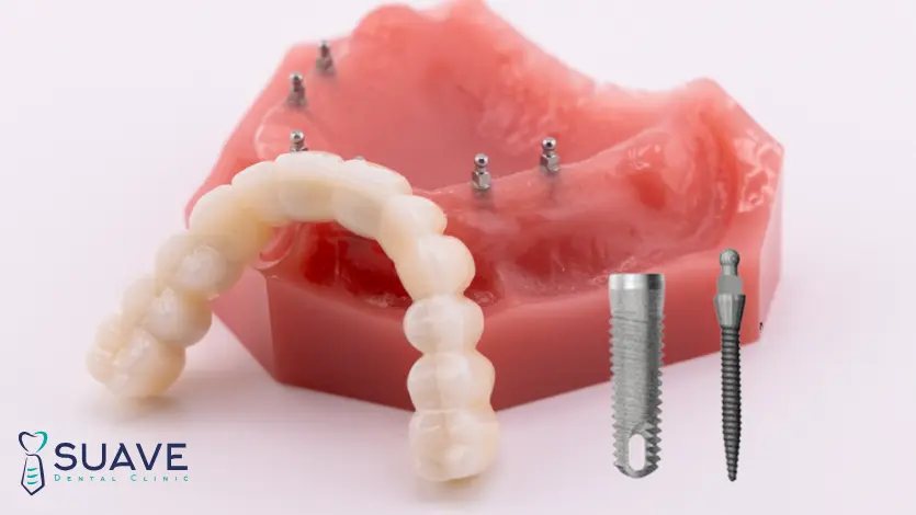 affordable mini dental implants in Turkey