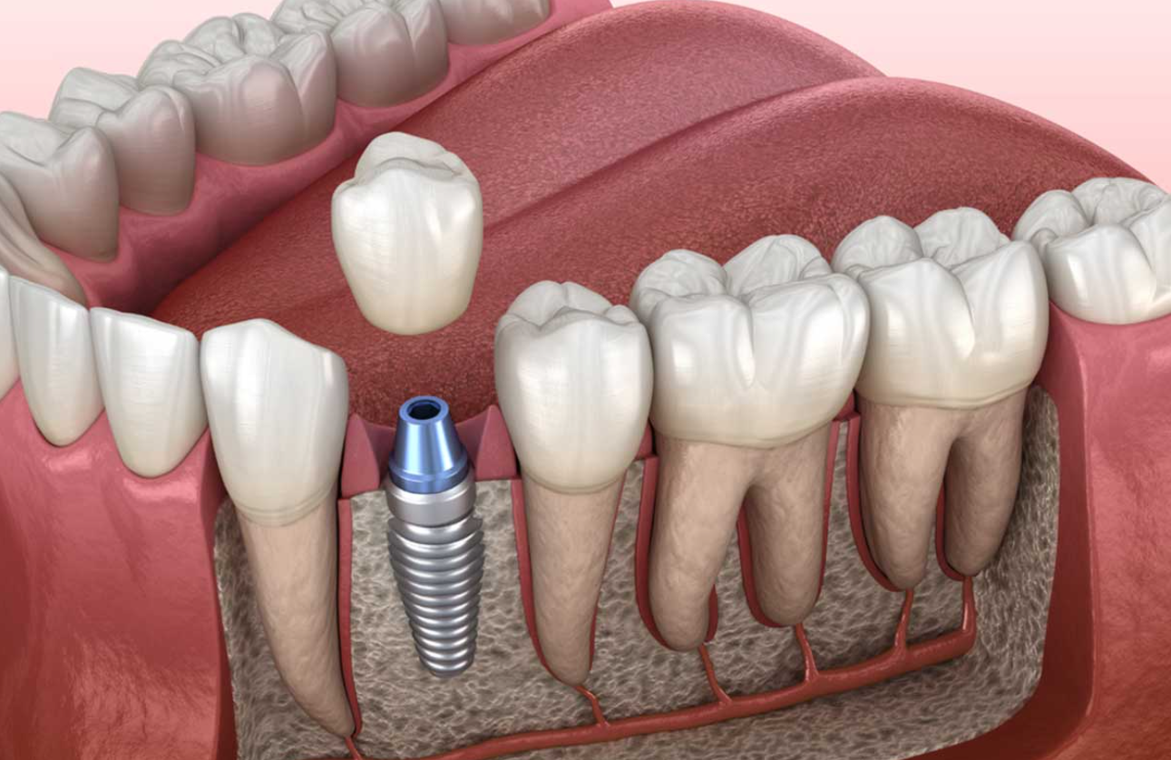 A single dental implant in Suave Clinic 