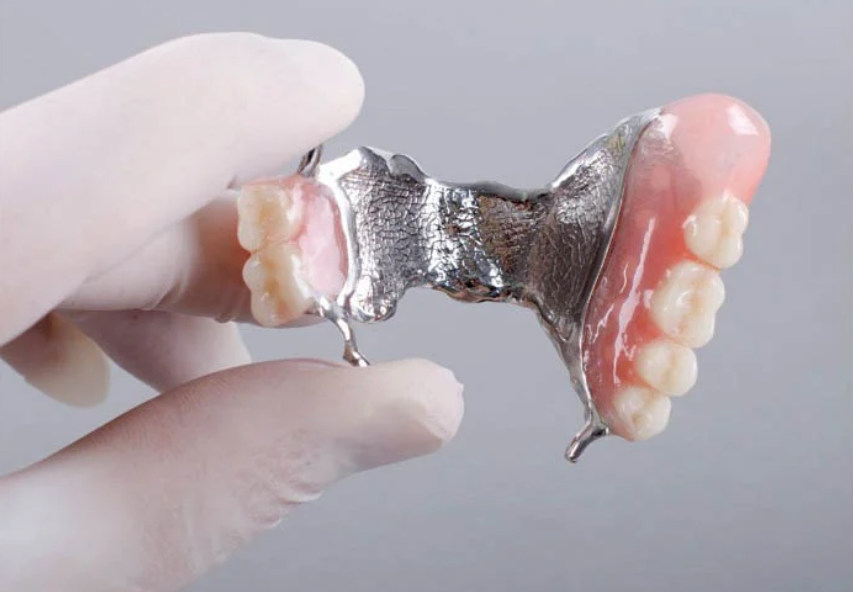 Acrylic denture with metal framework on the base and acrylic teeth