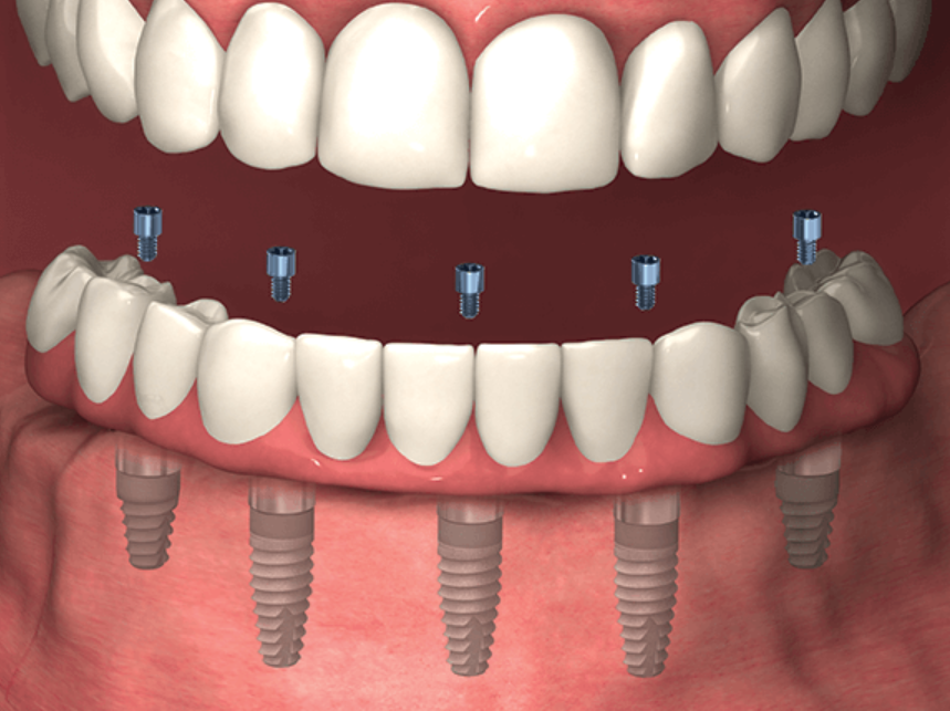 implant-retained dentures with screws