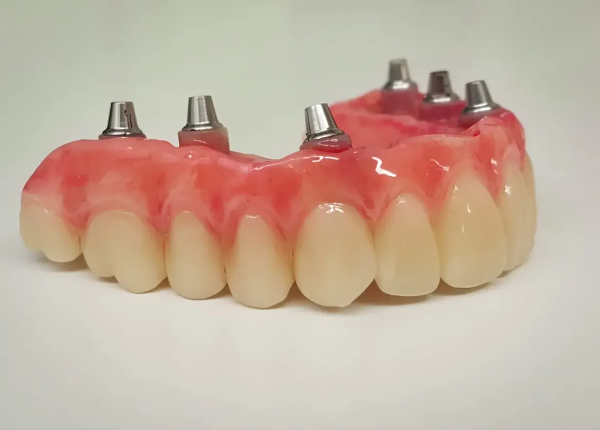implant-retained hybrid denture , fixed denture