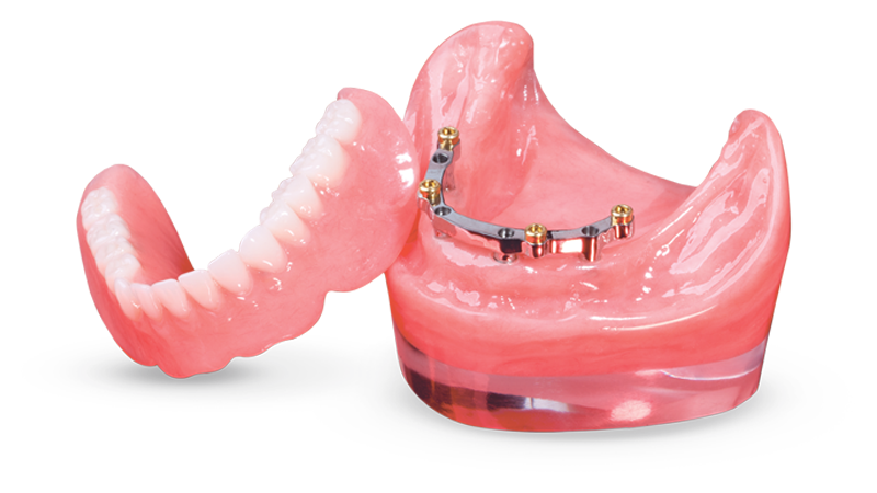 implant-supported overdenture with titanium bar locator