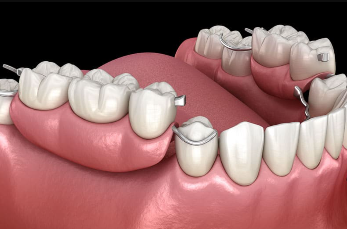 removable partial denture with metal clasps
