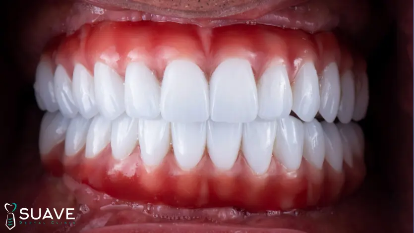 Suave Clinic Turkey Teeth in Turkey