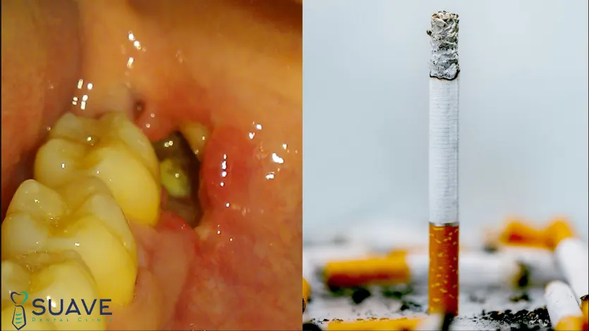 Dry socket as a result of a smoking after a tooth extraction