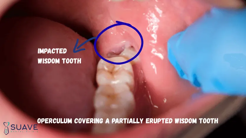 Wisdom Teeth Pain 8 operculum partially impacted wisdom tooth pain